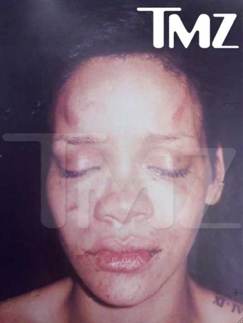 Rihanna Bruises